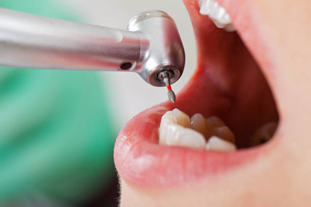 Best Emergency Wisdom Teeth Removal in Mulberry, FL